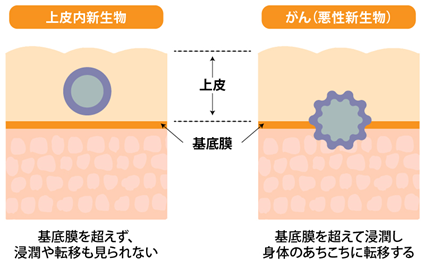 良性新生物と悪性新生物